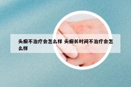 頭癬不治療會(huì)怎么樣 頭癬長時(shí)間不治療會(huì)怎么樣