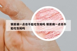 銀屑病一點(diǎn)也不能吃生蠔嗎 銀屑病一點(diǎn)也不能吃生蠔嗎