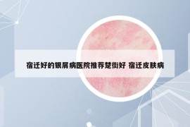 宿遷好的銀屑病醫(yī)院推薦楚街好 宿遷皮膚病