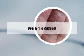 西安有牛皮癬醫(yī)院嗎