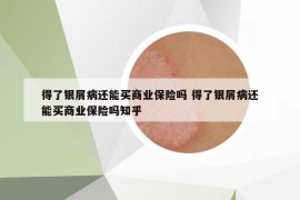 得了銀屑病還能買(mǎi)商業(yè)保險(xiǎn)嗎 得了銀屑病還能買(mǎi)商業(yè)保險(xiǎn)嗎知乎