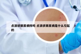 點(diǎn)滴狀銀屑病樣嗎 點(diǎn)滴狀銀屑病是什么引起的