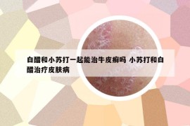 白醋和小蘇打一起能治牛皮癬嗎 小蘇打和白醋治療皮膚病