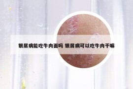 銀屑病能吃牛肉面嗎 銀屑病可以吃牛肉干嘛