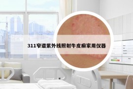 311窄譜紫外線照射牛皮癬家用儀器