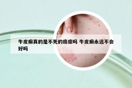 牛皮癬真的是不死的癌癥嗎 牛皮癬永遠(yuǎn)不會(huì)好嗎