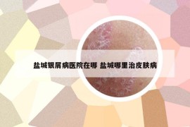 鹽城銀屑病醫(yī)院在哪 鹽城哪里治皮膚病