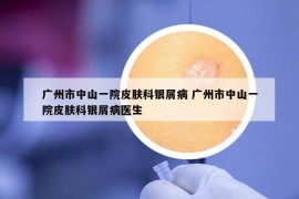 廣州市中山一院皮膚科銀屑病 廣州市中山一院皮膚科銀屑病醫(yī)生