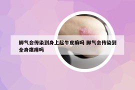 腳氣會傳染到身上起牛皮癬嗎 腳氣會傳染到全身瘙癢嗎