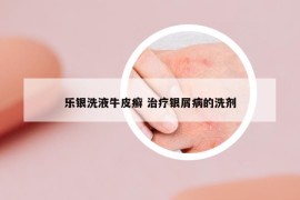 樂銀洗液牛皮癬 治療銀屑病的洗劑
