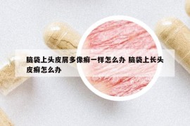 腦袋上頭皮屑多像癬一樣怎么辦 腦袋上長頭皮癬怎么辦