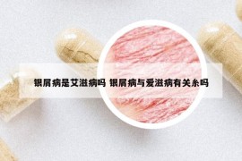 銀屑病是艾滋病嗎 銀屑病與愛滋病有關糸嗎