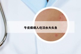 牛皮癬病人吃淡水大頭魚