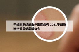 干細胞重組能治療銀屑病嗎 2021干細胞治療銀屑病最新公布