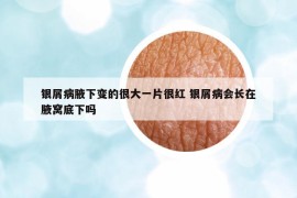 銀屑病腋下變的很大一片很紅 銀屑病會(huì)長(zhǎng)在腋窩底下嗎