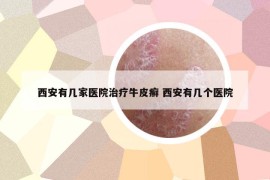 西安有幾家醫(yī)院治療牛皮癬 西安有幾個(gè)醫(yī)院