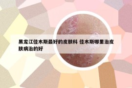 黑龍江佳木斯最好的皮膚科 佳木斯哪里治皮膚病治的好