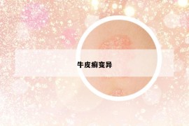 牛皮癬變異