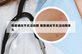 銀屑病關(guān)節(jié)炎活動期 銀屑病關(guān)節(jié)炎活動期多久