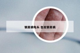 銀屑病龜頭 包皮銀屑病