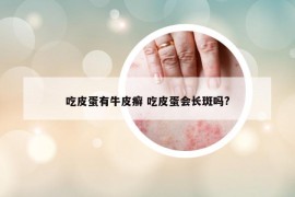 吃皮蛋有牛皮癬 吃皮蛋會長斑嗎?