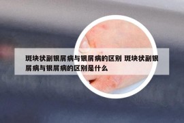 斑塊狀副銀屑病與銀屑病的區(qū)別 斑塊狀副銀屑病與銀屑病的區(qū)別是什么