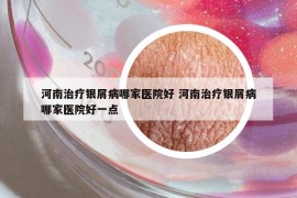 河南治療銀屑病哪家醫(yī)院好 河南治療銀屑病哪家醫(yī)院好一點