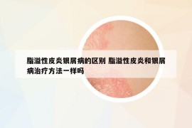 脂溢性皮炎銀屑病的區(qū)別 脂溢性皮炎和銀屑病治療方法一樣嗎
