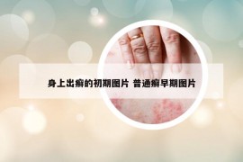 身上出癬的初期圖片 普通癬早期圖片