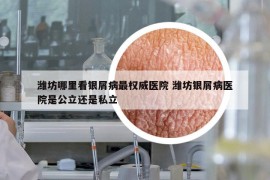 濰坊哪里看銀屑病最權(quán)威醫(yī)院 濰坊銀屑病醫(yī)院是公立還是私立