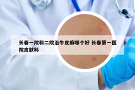 長春一院和二院治牛皮癬哪個好 長春第一醫(yī)院皮膚科