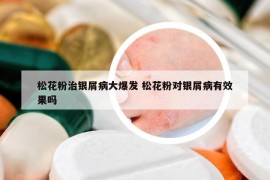 松花粉治銀屑病大爆發(fā) 松花粉對銀屑病有效果嗎