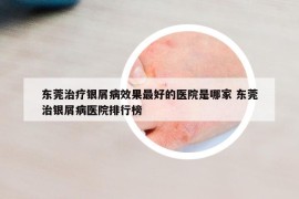 東莞治療銀屑病效果最好的醫(yī)院是哪家 東莞治銀屑病醫(yī)院排行榜