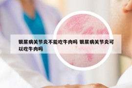銀屑病關(guān)節(jié)炎不能吃牛肉嗎 銀屑病關(guān)節(jié)炎可以吃牛肉嗎