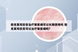 他克莫司軟膏治療銀屑病可以長期使用嗎 他克莫司軟膏可以治療銀屑病嗎?