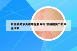 銀屑病關(guān)節(jié)炎看中醫(yī)有用嗎 銀屑病關(guān)節(jié)炎中醫(yī)診斷