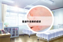 普通牛皮癬的癥狀
