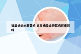 銀屑病能吃蕨菜嗎 銀屑病能吃蕨菜嗎百度百科