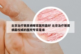 北京治療銀屑病哪家醫(yī)院最好 北京治療銀屑病最權威的醫(yī)院專家是誰
