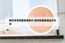 斑塊尋常型銀屑病常識(shí) 斑塊型銀屑病治療方法