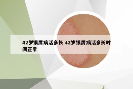 42歲銀屑病活多長 42歲銀屑病活多長時間正常