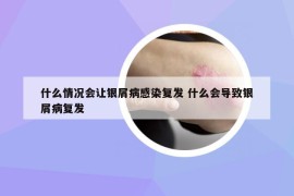 什么情況會(huì)讓銀屑病感染復(fù)發(fā) 什么會(huì)導(dǎo)致銀屑病復(fù)發(fā)