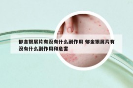 郁金銀屑片有沒有什么副作用 郁金銀屑片有沒有什么副作用和危害