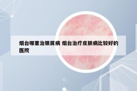 煙臺哪里治銀屑病 煙臺治療皮膚病比較好的醫(yī)院