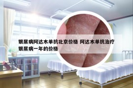 銀屑病阿達(dá)木單抗北京價(jià)格 阿達(dá)木單抗治療銀屑病一年的價(jià)格