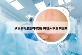 頑固腳趾根部牛皮癬 腳趾頭銀屑病圖片