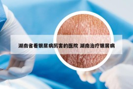 湖南省看銀屑病厲害的醫(yī)院 湖南治療銀屑病