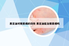 黑豆油對銀屑病的功效 黑豆油能治銀屑病嗎