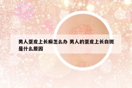 男人蛋皮上長癬怎么辦 男人的蛋皮上長白斑是什么原因