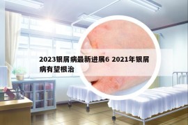 2023銀屑病最新進展6 2021年銀屑病有望根治